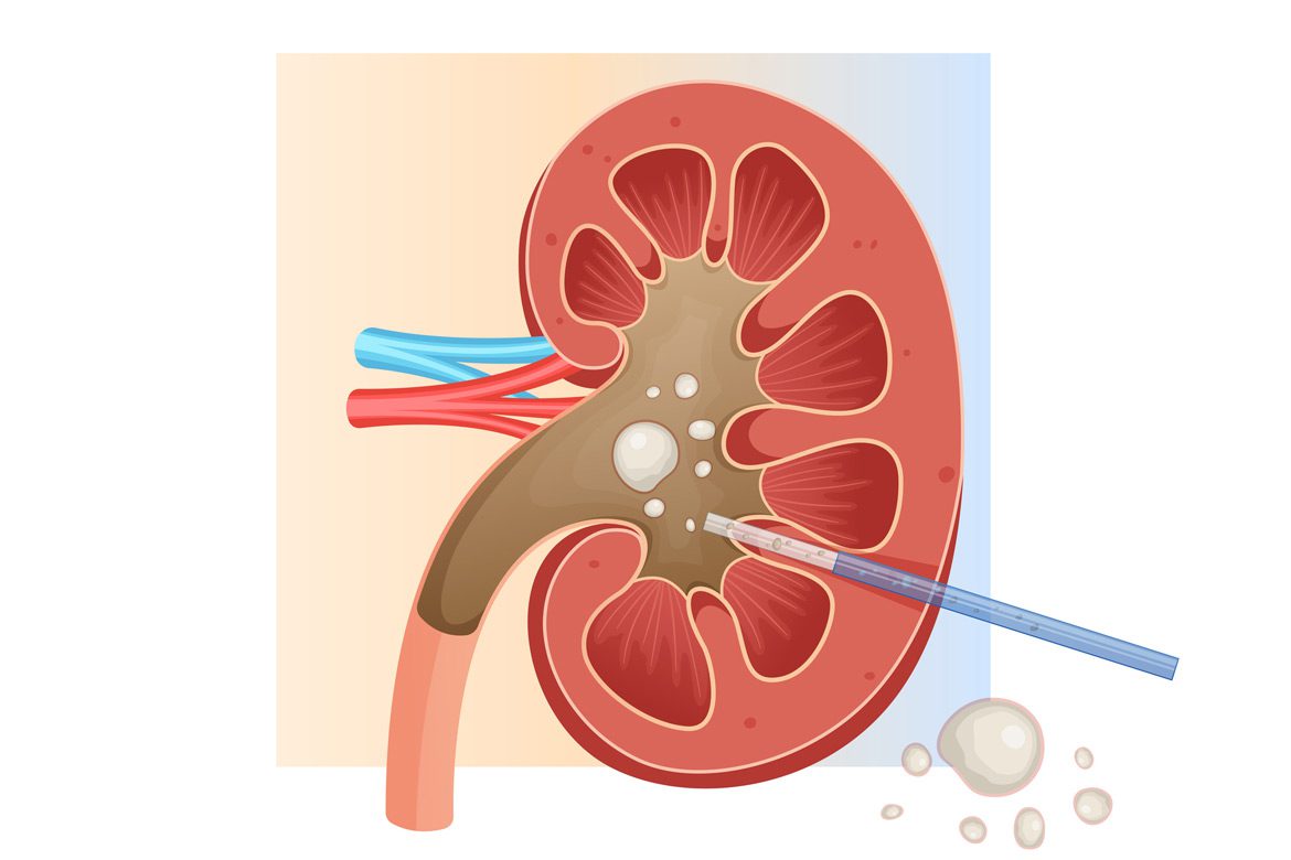 Illustration-of-percutaneous-nephrolithotomy
