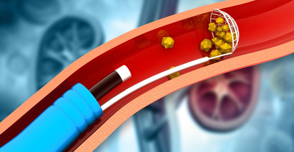 3D-illustration-showing-kidney-stone-removal-procedure