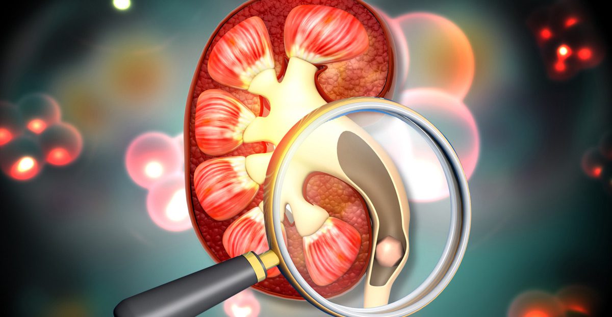 Finding-kidney-stones-using-magnifying-glass
