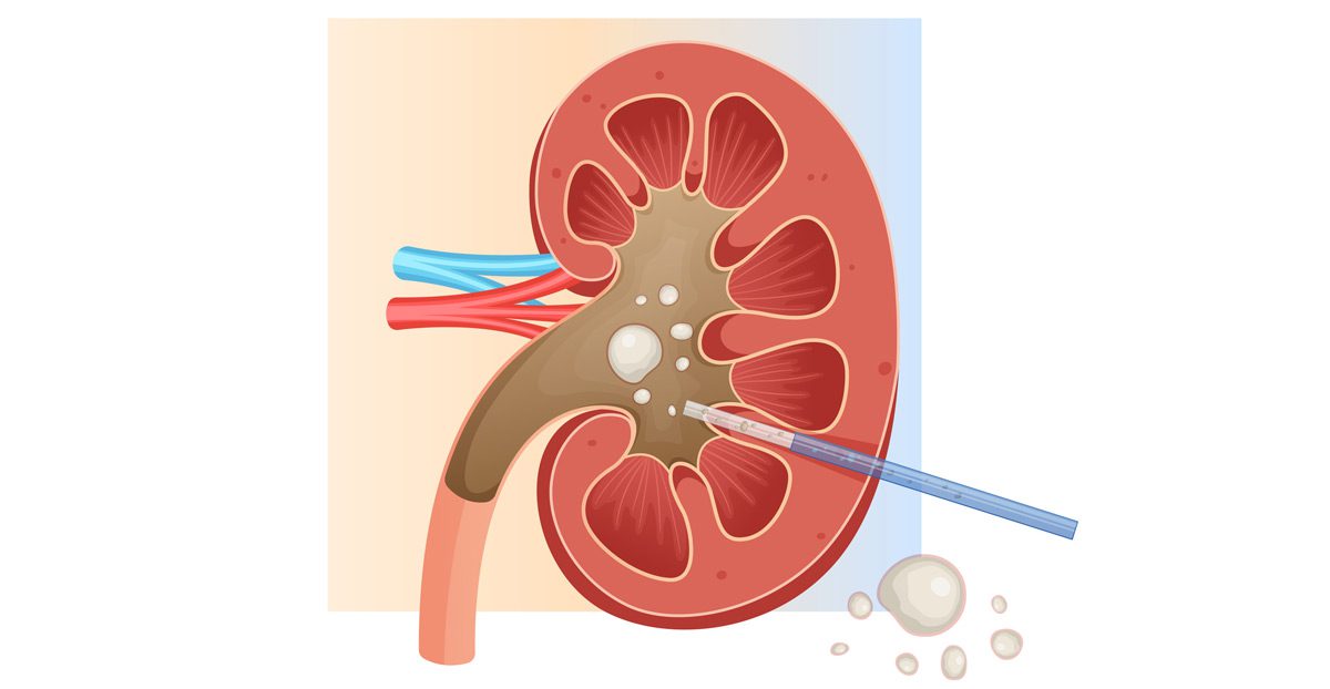 Illustration-of-percutaneous-nephrolithotomy