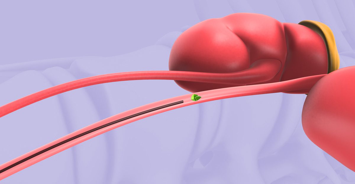 Illustration-of-ureteroscopy-and-laser-lithotripsy-procedure