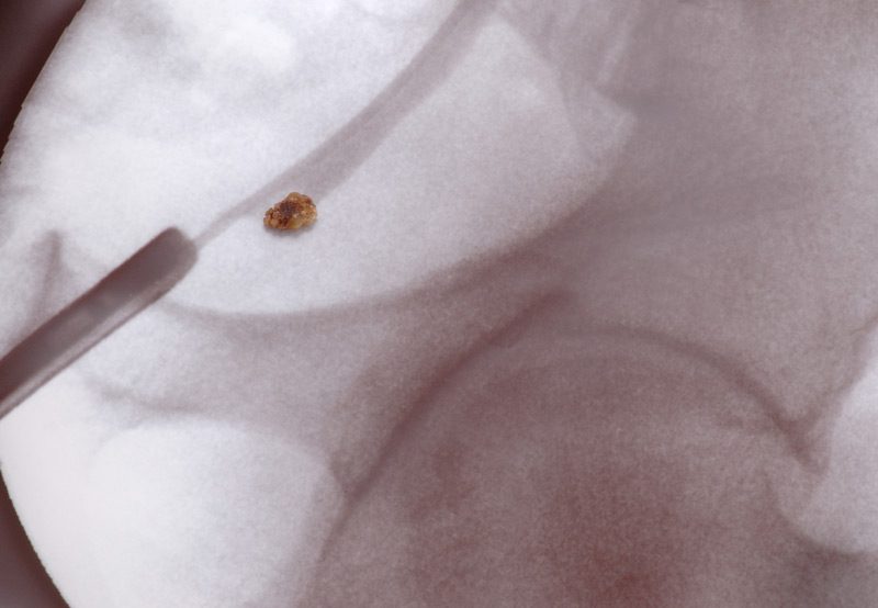 Kidney-stone-positioned-on-x-ray