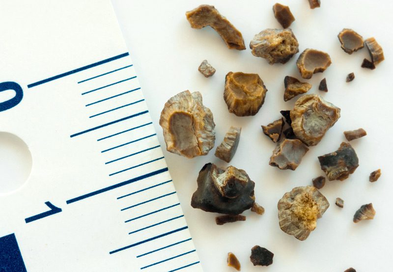 Kidney-stones-collected-after-extracorporeal-shock-wave-lithotripsy