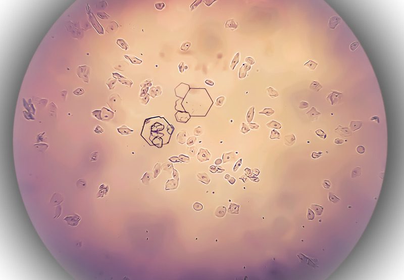 Microscopic-view-of-cystine-crystals